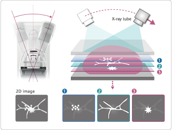 [Imagem] Tomossíntese: possibilitando observar a estrutura interna da mama